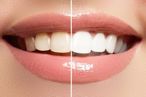 5 Natural Ways to Whiten Your Teeth at Home