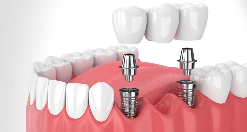 Dental Implant: Why & How?