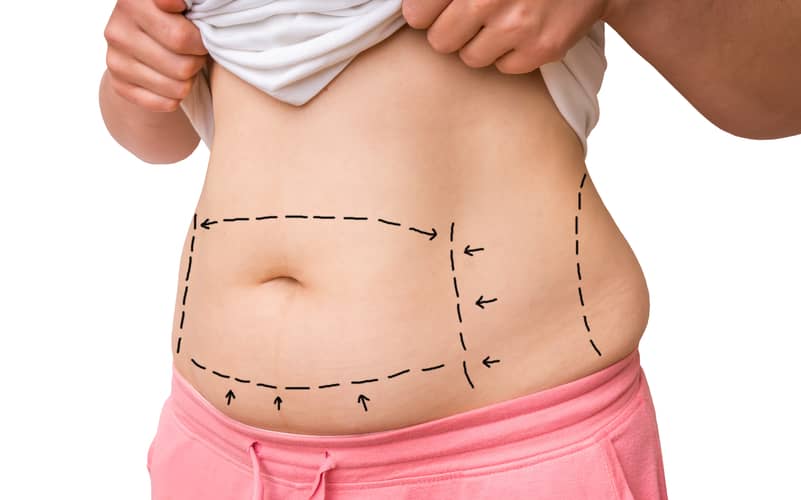 Are There Medical Reasons for Wanting a Tummy Tuck?