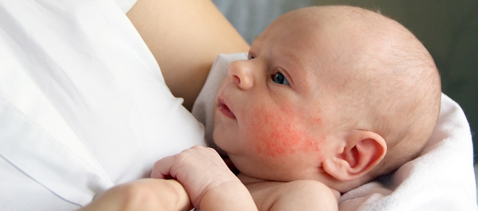 Common Skin Allergies in Babies and Natural Remedies for Them