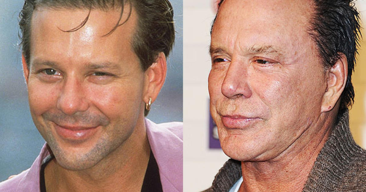 What Are Some Common Plastic Surgery Botch Jobs?