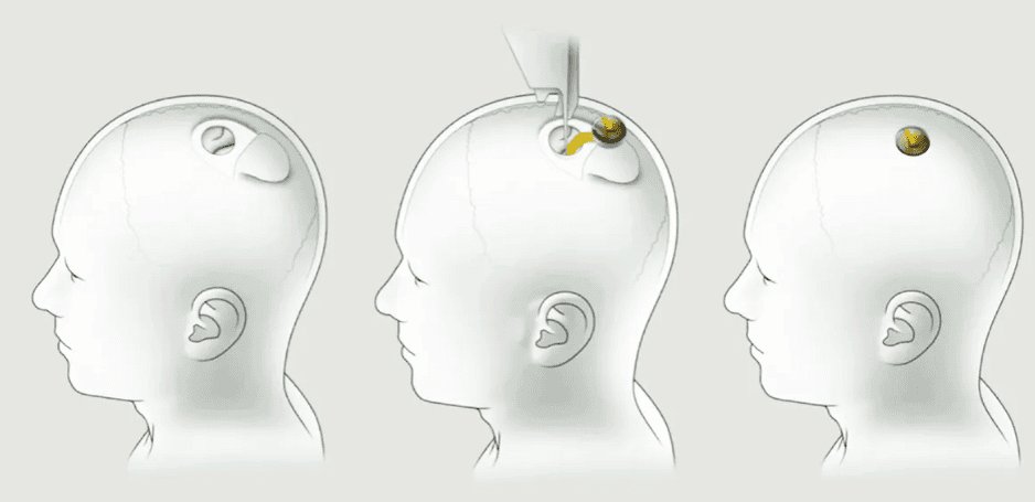 China Challenges Neuralink: The Rise of Brain-Computer Interfaces in the East