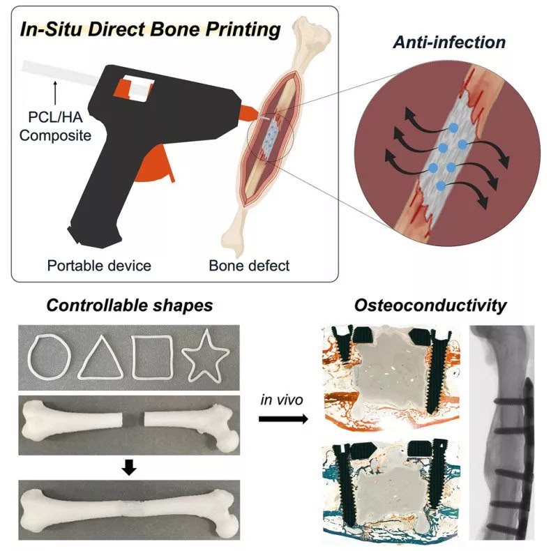 Korean Innovators Transform Glue Gun into Breakthrough Bone Repair Device