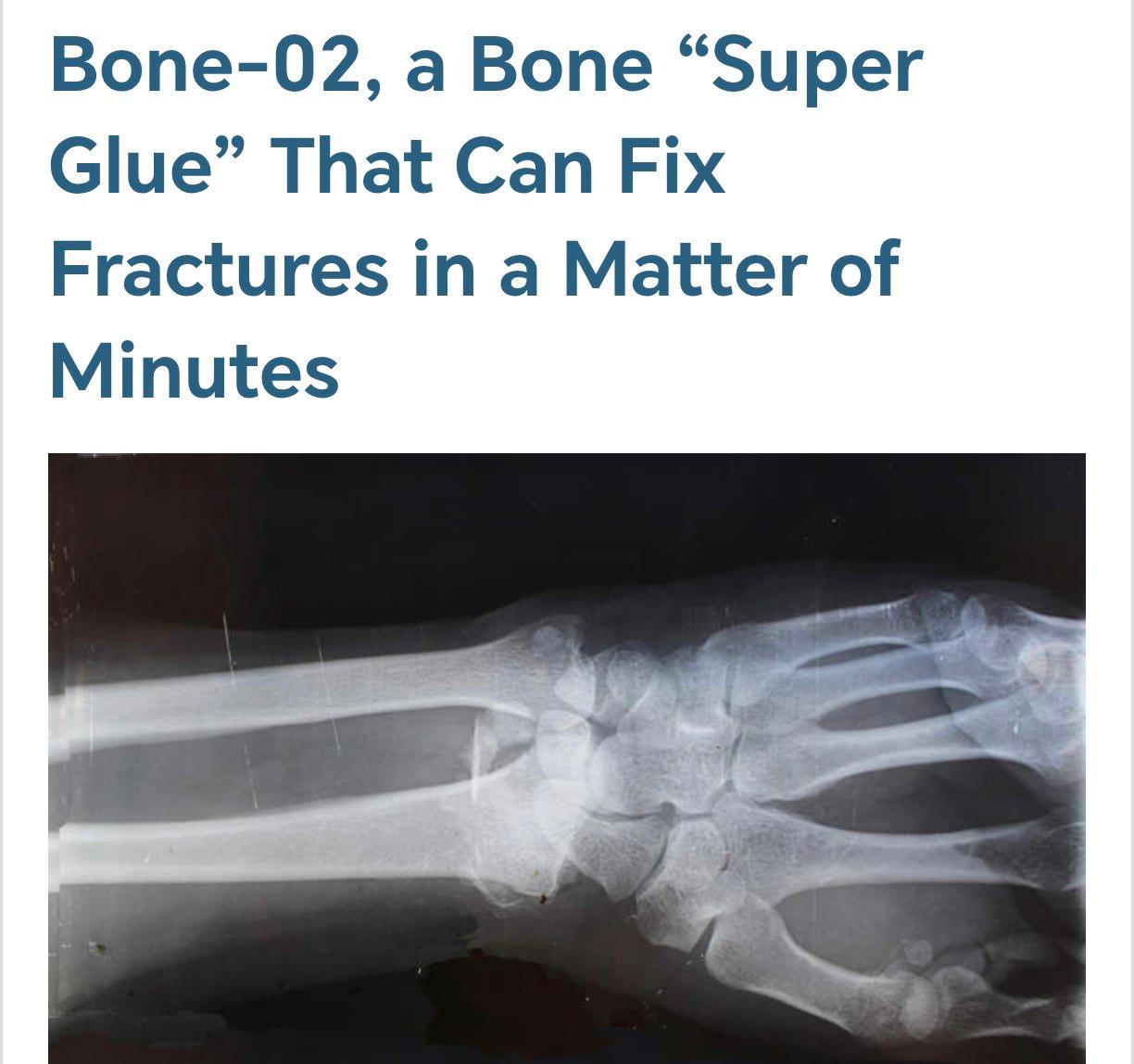 Healing in Minutes: China's Bone-02 "Bone Glue" Revolutionizes Fracture Repair