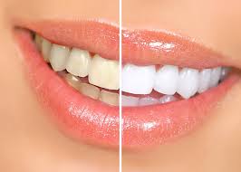 5 Natural Ways to Whiten Your Teeth at Home