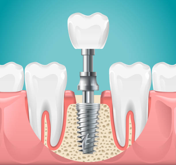 Dental Implant: Why & How?