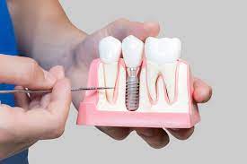 Dental Implant: Why & How?