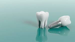 Dental Implant: Why & How?