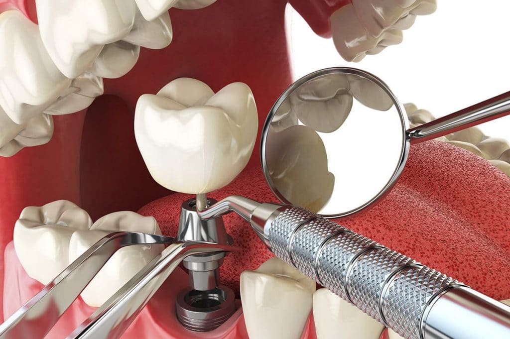 Dental Implant: Why & How?