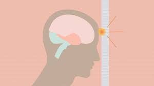 7 Key Facts About Traumatic Brain Injuries