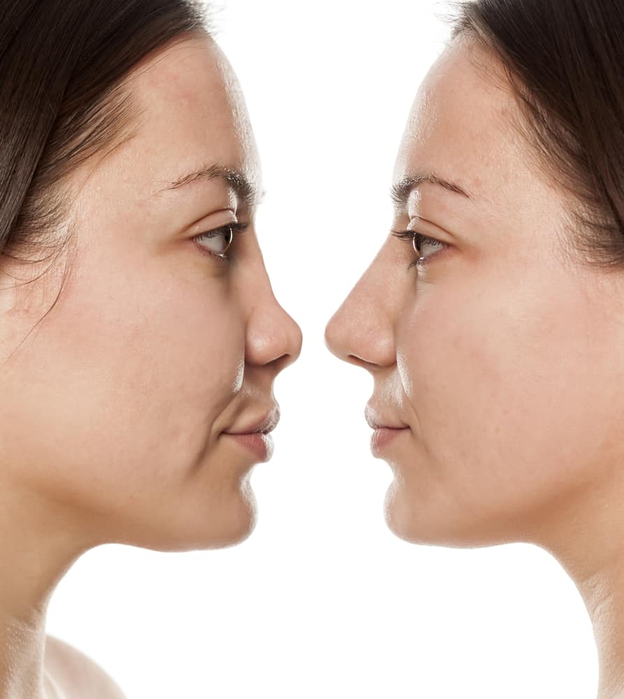 How Many Types of Nose Surgery Are There?