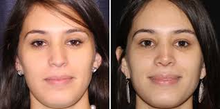 How Many Types of Nose Surgery Are There?
