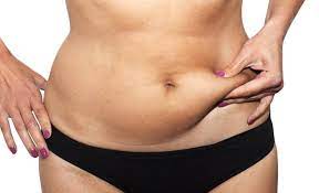 Are There Medical Reasons for Wanting a Tummy Tuck?