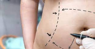 Are There Medical Reasons for Wanting a Tummy Tuck?