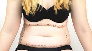 Are There Medical Reasons for Wanting a Tummy Tuck?