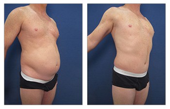 Are There Medical Reasons for Wanting a Tummy Tuck?