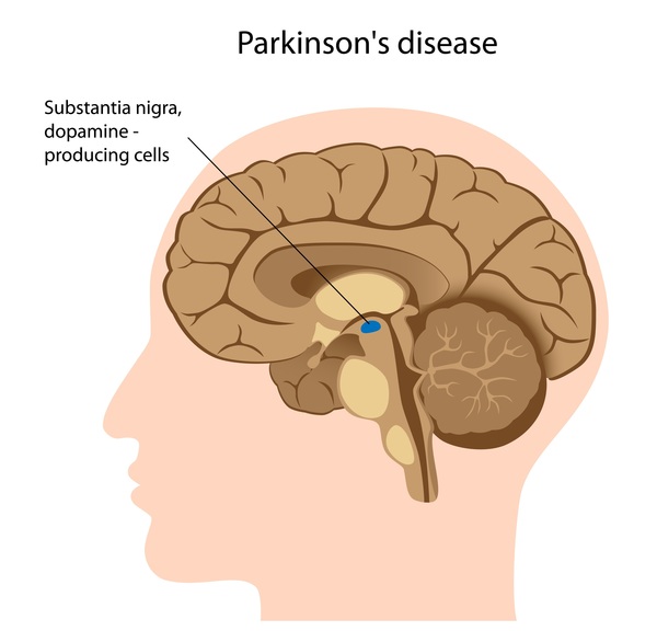 Different Stages of Parkinson’s Disease, Early Diagnosis, and Treatments
