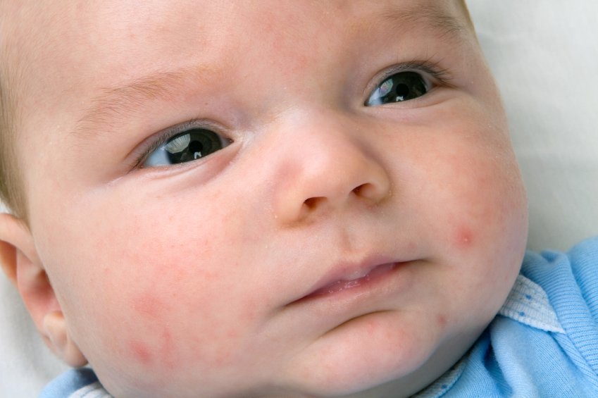 Common Skin Allergies in Babies and Natural Remedies for Them
