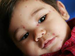Common Skin Allergies in Babies and Natural Remedies for Them