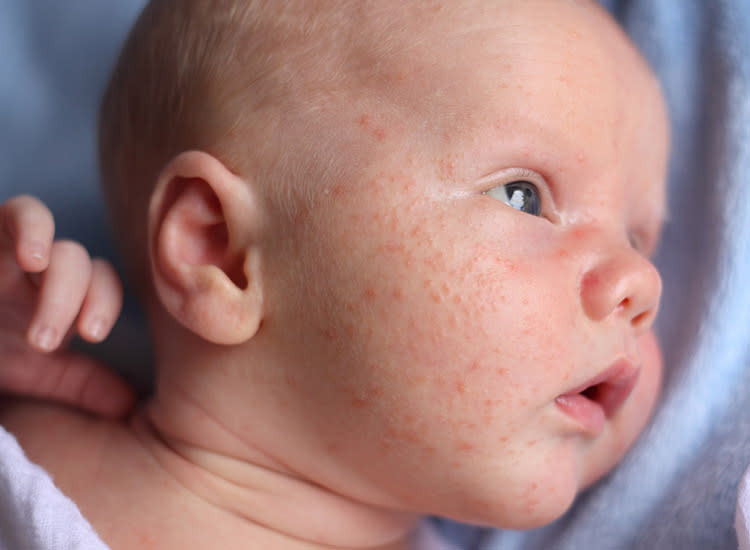 Common Skin Allergies in Babies and Natural Remedies for Them