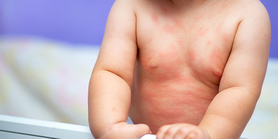 Common Skin Allergies in Babies and Natural Remedies for Them