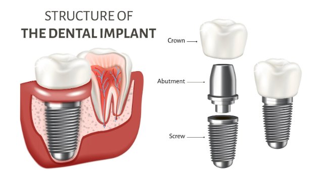 Natural Hollywood Smile Design 2026: The New Era of Bio-Mimetic Beauty