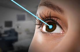 eye lasik