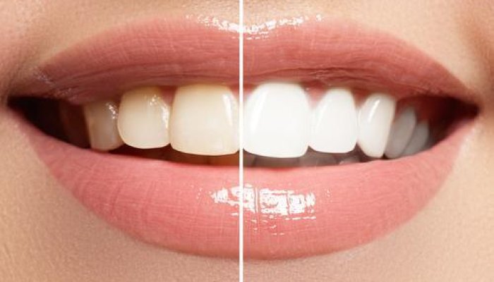 5 Natural Ways to Whiten Your Teeth at Home