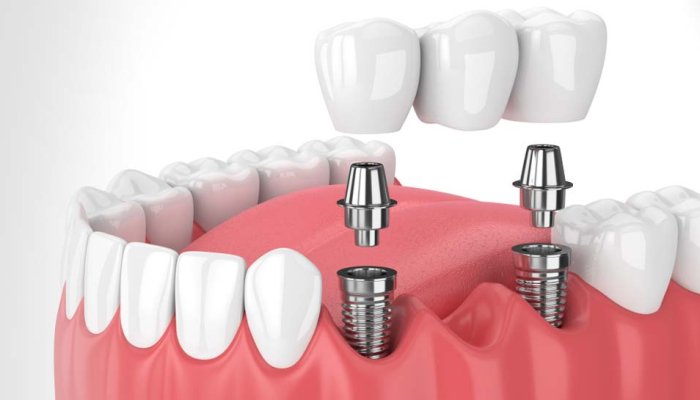 Dental Implant: Why & How?