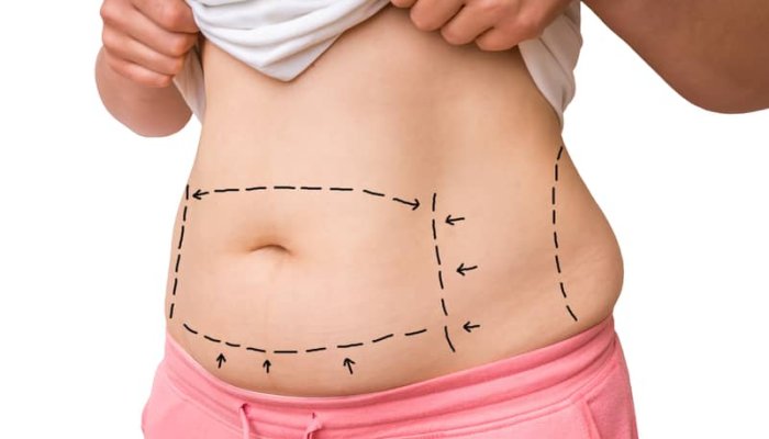 Are There Medical Reasons for Wanting a Tummy Tuck?