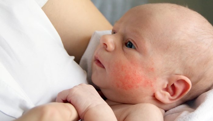 Common Skin Allergies in Babies and Natural Remedies for Them