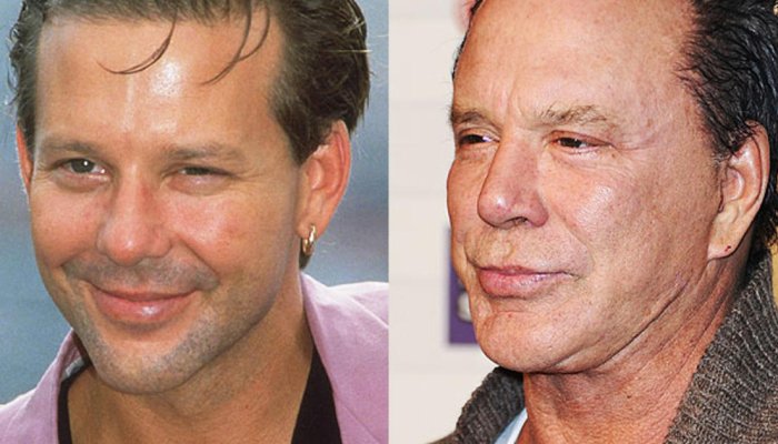 What Are Some Common Plastic Surgery Botch Jobs?